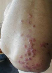 Dermatitis Herpetiformis Rash